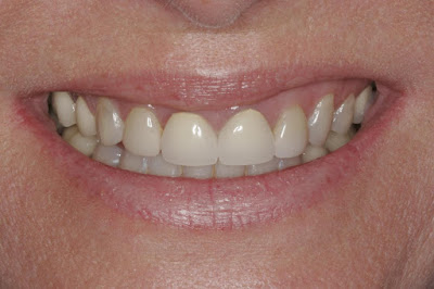 Ποιοι οι λόγοι που τρίβονται τα δόντια; Πώς αντιμετωπίζεται η αποτριβή των δοντιών;