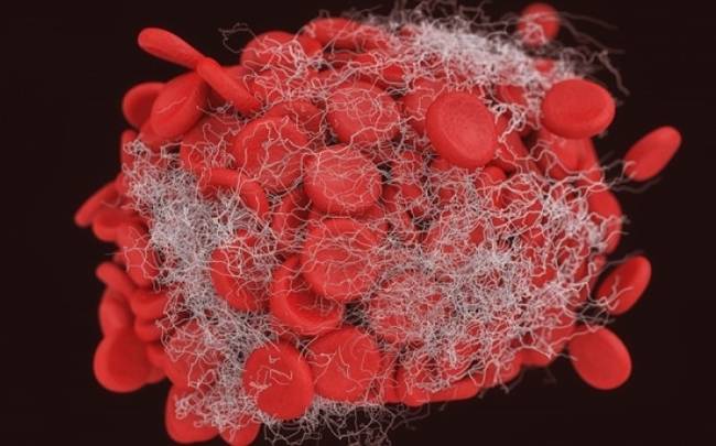 Τι γνωρίζετε για τη θρόμβωση;