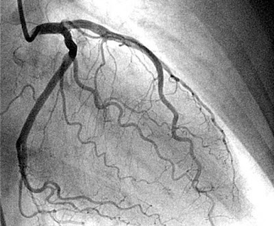 Ποιες εξετάσεις πρέπει να γίνουν στο έμφραγμα; Τι είναι η τροπονίνη;