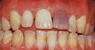 Απορρόφηση οδοντικής ρίζας, με πόνο, δυσχρωμία και κινητικότητα δοντιού