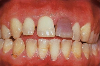 Απορρόφηση οδοντικής ρίζας, με πόνο, δυσχρωμία και κινητικότητα δοντιού