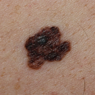 Διπλάσιος ο κίνδυνος μελανώματος σε όσους εργάζονται εκτεθειμένοι στον ήλιο