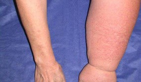 Ημέρα Ενημέρωσης για το Λεμφοίδημα. Τι είναι και πώς παρουσιάζεται; (video)