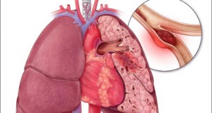 Θεραπεία της θρόμβωσης σε ογκολογικούς ασθενείς με Hπαρίνη χαμηλού μοριακού βάρους