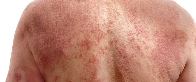 Ο καρκίνος του δέρματος προλαμβάνεται. Μην ξεχνιόμαστε και η άνοιξη θέλει το αντηλιακό της