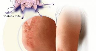 Ψώρα. Επικίνδυνη μεταδοτική δερματική νόσος. Πώς αντιμετωπίζεται; Μέτρα πρόληψης