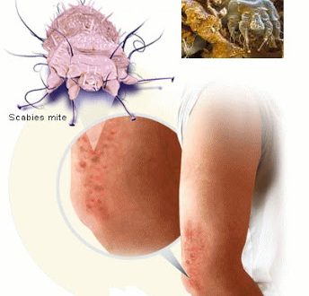 Ψώρα. Επικίνδυνη μεταδοτική δερματική νόσος. Πώς αντιμετωπίζεται; Μέτρα πρόληψης