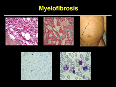 Βελτίωση της νόσου σε ασθενείς με μυελοΐνωση και αληθή πολυκυτταραιμία. Νέα θεραπευτικά δεδομένα
