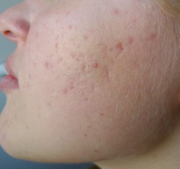 Ποια η αιτία της αυξημένης τριχοφυΐας στις γυναίκες; Τι είναι η υπερτρίχωση και ο δασυτριχισμός;