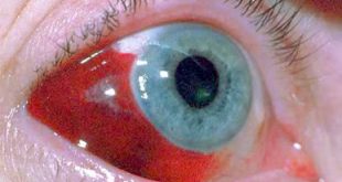 Αίμα από σπασμένα αιμοφόρα αγγεία στο μάτι. Πόσο σοβαρό είναι το υπόσφαγμα;