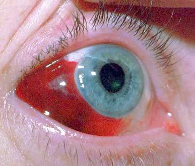 Αίμα από σπασμένα αιμοφόρα αγγεία στο μάτι. Πόσο σοβαρό είναι το υπόσφαγμα;