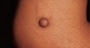 Δερματοΐνωμα, μοιάζει με σπυράκι, στο δέρμα και είναι σκληρό σαν κάτι να έχει μέσα