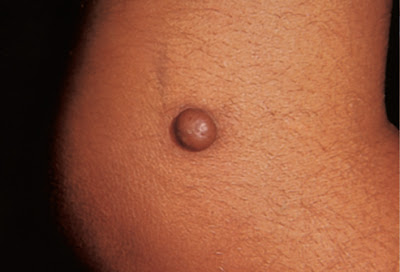 Δερματοΐνωμα, μοιάζει με σπυράκι, στο δέρμα και είναι σκληρό σαν κάτι να έχει μέσα