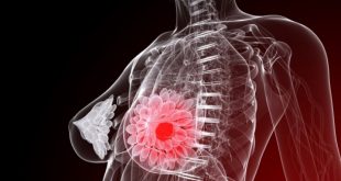 Καρκίνος μαστού: Η διατροφή που αποτρέπει την επανεμφάνιση της νόσου