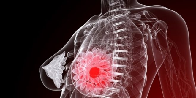Καρκίνος μαστού: Η διατροφή που αποτρέπει την επανεμφάνιση της νόσου