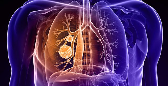 Καρκίνος του πνεύμονα, που δεν σχετίζεται με το κάπνισμα, αντιμετωπίζεται καλύτερα με φάρμακο, που αποζημιώνεται και στην Ελλάδα