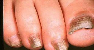 Αισθάνεστε έντονη φαγούρα ανάμεσα στα δάχτυλα των ποδιών σας; Μύκητες νυχιών και δέρματος. Φυσικές θεραπείες