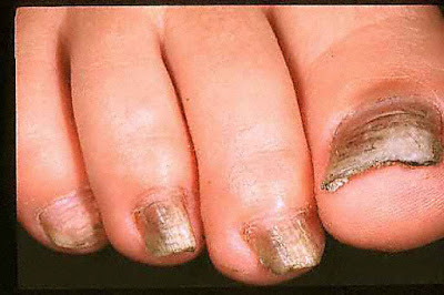 Αισθάνεστε έντονη φαγούρα ανάμεσα στα δάχτυλα των ποδιών σας; Μύκητες νυχιών και δέρματος. Φυσικές θεραπείες