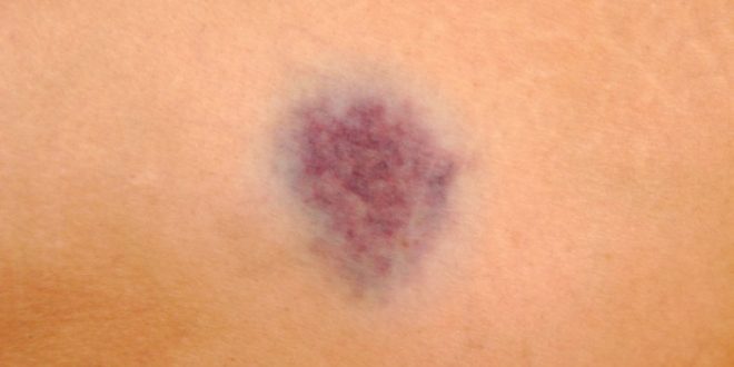 Ανεξήγητες μελανιές: Τι δείχνουν για το συκώτι