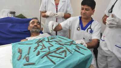 Γιατροί αφαίρεσαν 40 μαχαίρια από το στομάχι αστυνομικού!