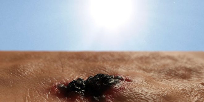 Καρκίνος δέρματος: Τα προειδοποιητικά σημάδια μέσα από φωτογραφίες
