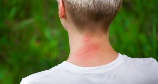 Σας τσίμπησε κουνούπι; Τρία γιατροσόφια για να ανακουφιστείτε από τη φαγούρα