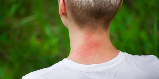 Σας τσίμπησε κουνούπι; Τρία γιατροσόφια για να ανακουφιστείτε από τη φαγούρα
