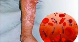 Πρώτη αιτία θανάτου το σηπτικό σύνδρομο. Τι είναι η σήψη, ποιοι κινδυνεύουν και πώς μπορεί να προληφθεί; Μύθοι και αλήθειες (video)