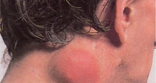 Τι είναι το λέμφωμα; Ποια τα συμπτώματα; Παγκόσμια Ημέρα Ευαισθητοποίησης για το Λέμφωμα (video)