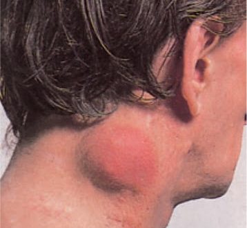 Τι είναι το λέμφωμα; Ποια τα συμπτώματα; Παγκόσμια Ημέρα Ευαισθητοποίησης για το Λέμφωμα (video)