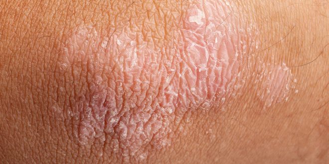 Ψωρίαση: Οι 7 τροφές που την επιδεινώνουν