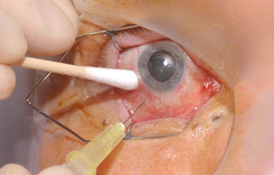 Αιτίες που μπορεί να χαθεί η όραση και τρόποι αντιμετώπισης. Παγκόσμια Ημέρα Όρασης