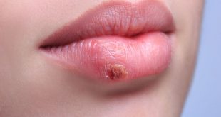 Επιχείλιος έρπης: 5 tips για να φύγει πιο γρήγορα