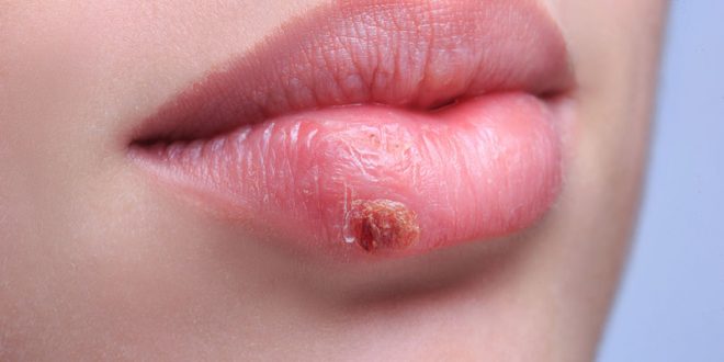 Επιχείλιος έρπης: 5 tips για να φύγει πιο γρήγορα