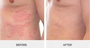 Φάρμακο για την ψωρίαση, της Novartis, επιτυγχάνει υψηλά επίπεδα κάθαρσης του δέρματος που διαρκεί