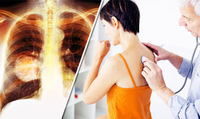 Ο καρκίνος του πνεύμονα συχνά δεν παρουσιάζει συμπτώματα παρά μόνο αφού φτάσει σε προχωρημένο στάδιο
