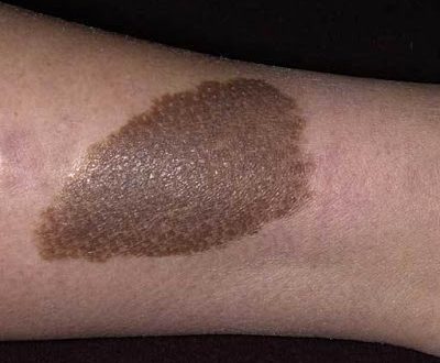 Τι είναι τα εκ γενετής σημάδια (birthmarks); Είναι επικίνδυνα;