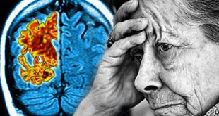 Ένα πολλά υποσχόμενο φάρμακο για το Αλτσχάιμερ αποτυγχάνει, απογοητεύοντας ερευνητές και ασθενείς