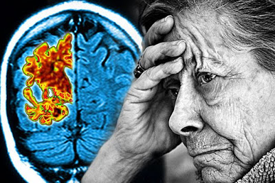 Ένα πολλά υποσχόμενο φάρμακο για το Αλτσχάιμερ αποτυγχάνει, απογοητεύοντας ερευνητές και ασθενείς