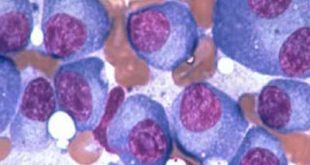 Η ιξαζομίμπη Έλαβε Υπό Όρους Έγκριση από την Ευρωπαϊκή Επιτροπή για τη Θεραπεία του Πολλαπλού Μυελώματος