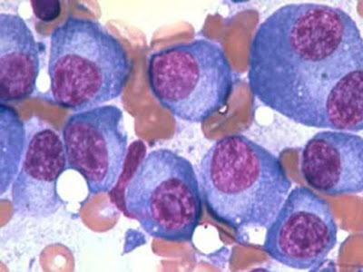 Η ιξαζομίμπη Έλαβε Υπό Όρους Έγκριση από την Ευρωπαϊκή Επιτροπή για τη Θεραπεία του Πολλαπλού Μυελώματος