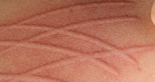 Μπορεί να γράψετε στο δέρμα σας, ασκώντας πίεση; Τι είναι ο δερμογραφισμός και πως αντιμετωπίζεται;