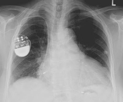 Ποινική δίωξη κατά εκπροσώπων δύο ελληνικών εταιριών-προμηθευτριών νοσοκομείων για υπερκοστολογήσεις