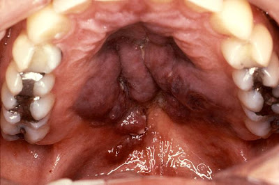 Τι πρέπει να γνωρίζετε για τον καρκίνο του στόματος. Πώς γίνεται η αυτοεξέταση