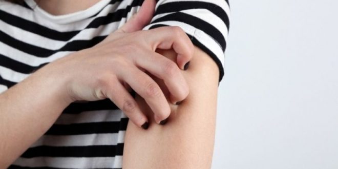 Έκζεμα: Πώς θα κλείσετε τον κύκλο της φαγούρας