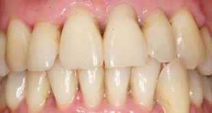 Η περιοδοντίτιδα συνδέεται με αυξημένο κίνδυνο εγκεφαλικού