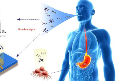 Τεστ αναπνοής ανιχνεύει καρκίνο του οισοφάγου και του στομάχου