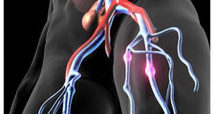 Η ριβαροξαμπάνη προλαμβάνει την υποτροπή της φλεβικής θρομβοεμβολής καλύτερα από το ακετυλοσαλικυλικό οξύ