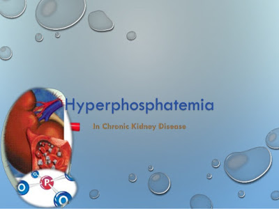 Νέο αποτελεσματικό φάρμακο για την υπερφωσφαταιμία, κάνει τους νεφροπαθείς να παίρνουν 2000 λιγότερα χάπια τον χρόνο