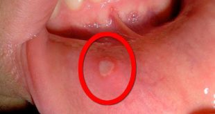 Άφθες, ενοχλητικές πληγές στο στόμα. Τι πρέπει να κάνετε με τις άφτρες;